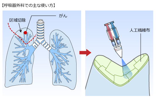 （２）呼吸器外科での主な使い方