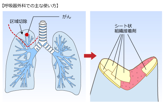 （１）呼吸器外科での主な使い方