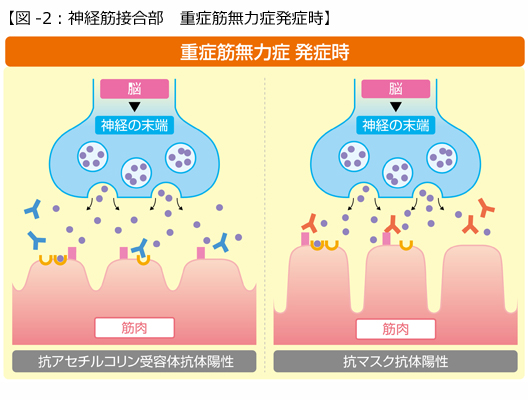 【図-2：神経筋接合部　重症筋無力症発症時】