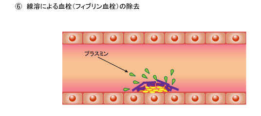 ６．線溶による血栓（フィブリン血栓）の除去