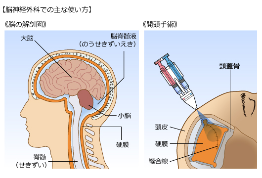 （１）脳神経外科での主な使い方