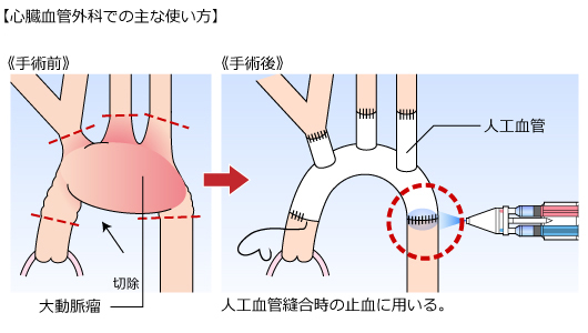 （３）心臓血管外科での主な使い方