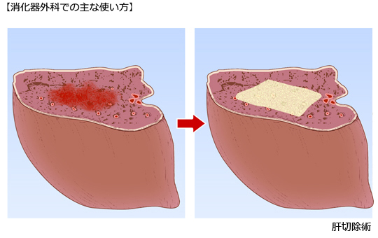 （３）消化器外科での主な使い方