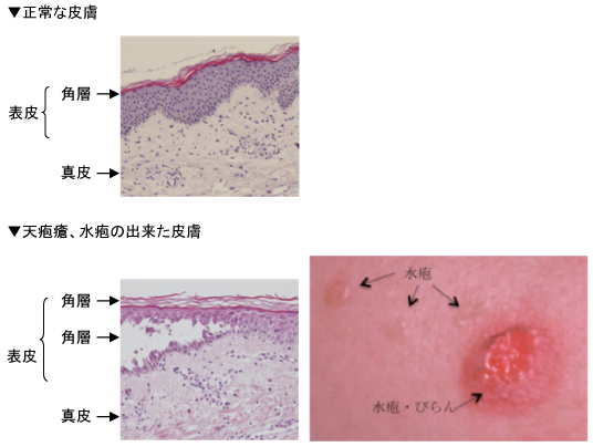 天疱瘡のイラスト