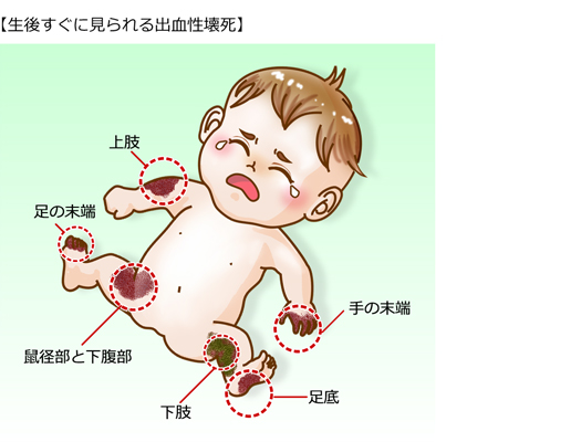 生後すぐに見られる出血性壊死